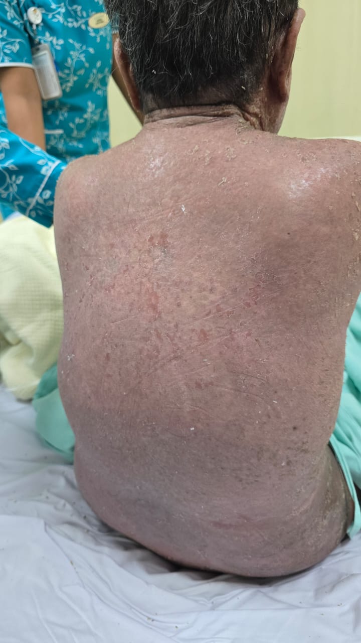 Severe eczema before treatment